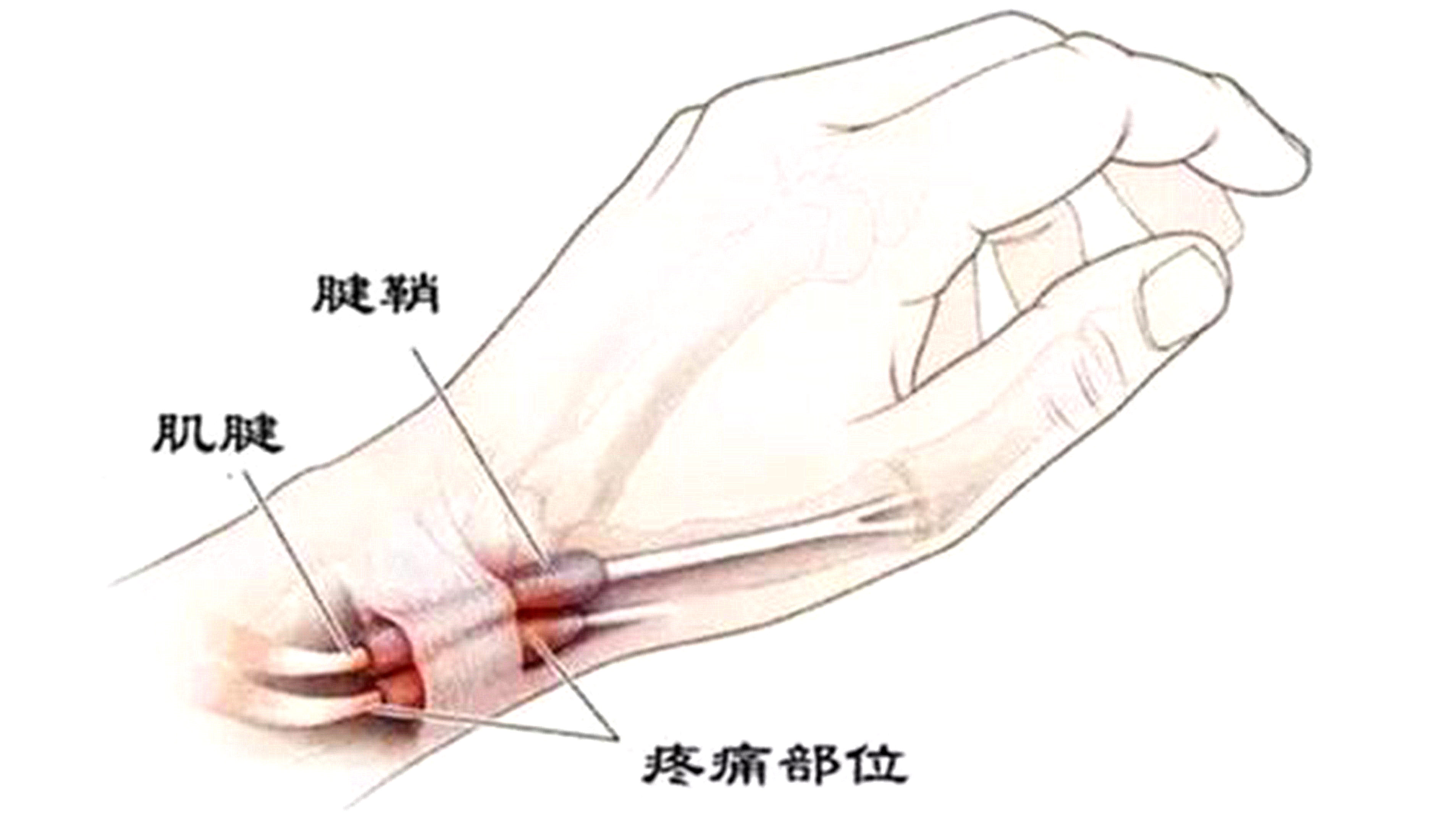 手腕酸痛的原因什么?怎么辦？